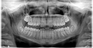 nowoczesne aparaty ortodontyczne