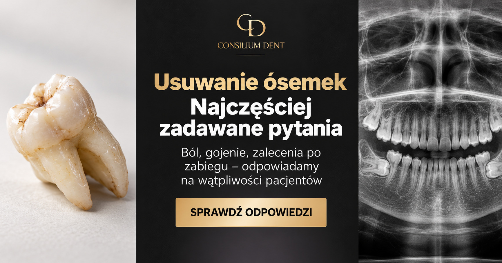 Ząb mądrości i poglądowe zdjęcie rentgenowskie zatrzymanych ósemek – ilustracja do artykułu z odpowiedziami na pytania pacjentów