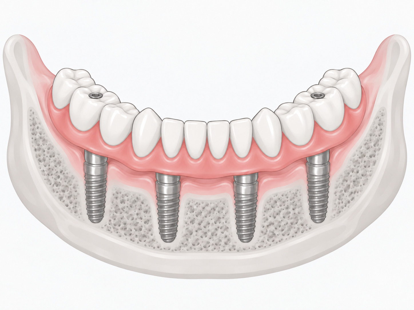 Ilustracja poglądowa: proteza stała na 4 implantach, most na całym łuku przykręcony do implantów w żuchwie